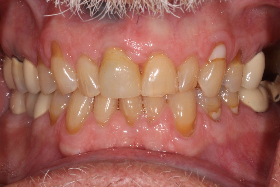 Dental Implants — after
