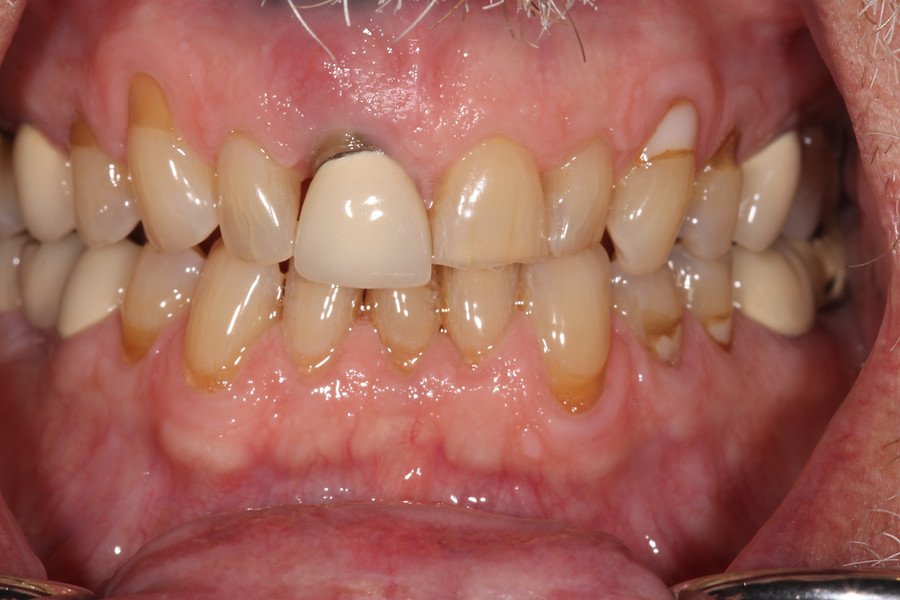 Dental Implants — before
