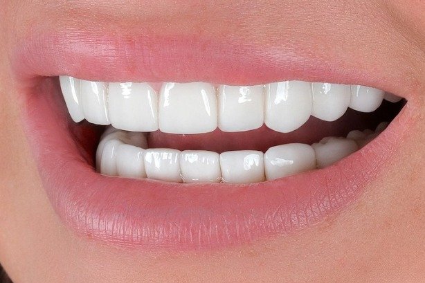 Dental Implants — after 2