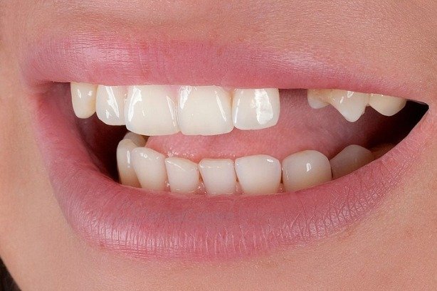 Dental Implants — before 2