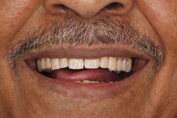 Dental Implants — after 3