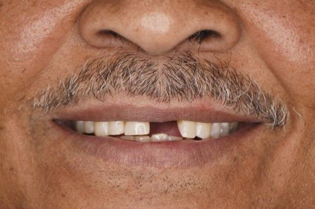 Dental Implants — before 3