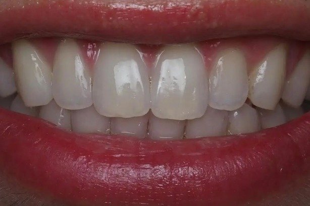Invisalign — after