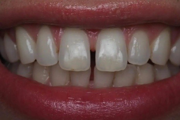 Invisalign — before