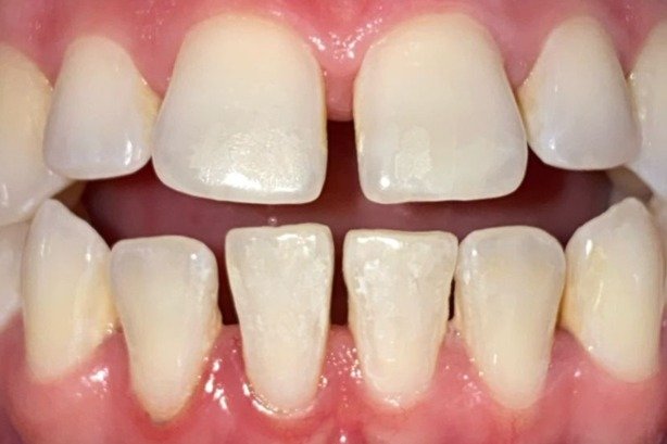 Cosmetic Dentistry — before