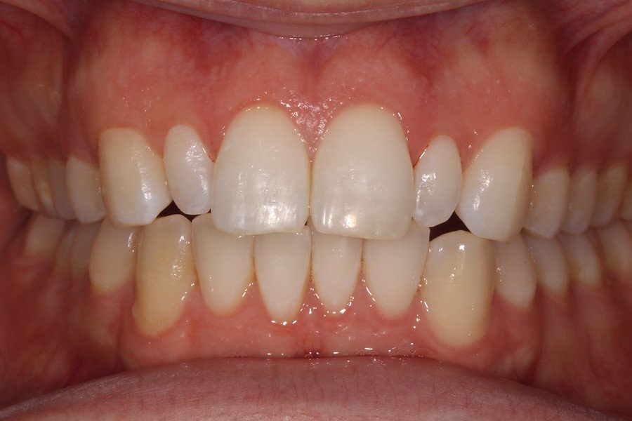 Cosmetic Dentistry — before