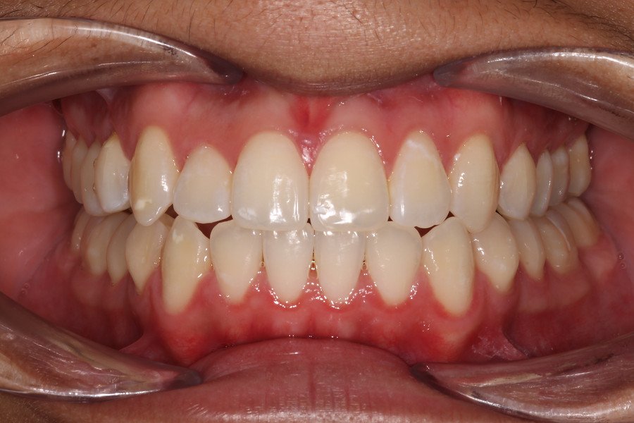 Invisalign — after