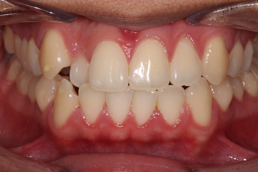 Invisalign — before