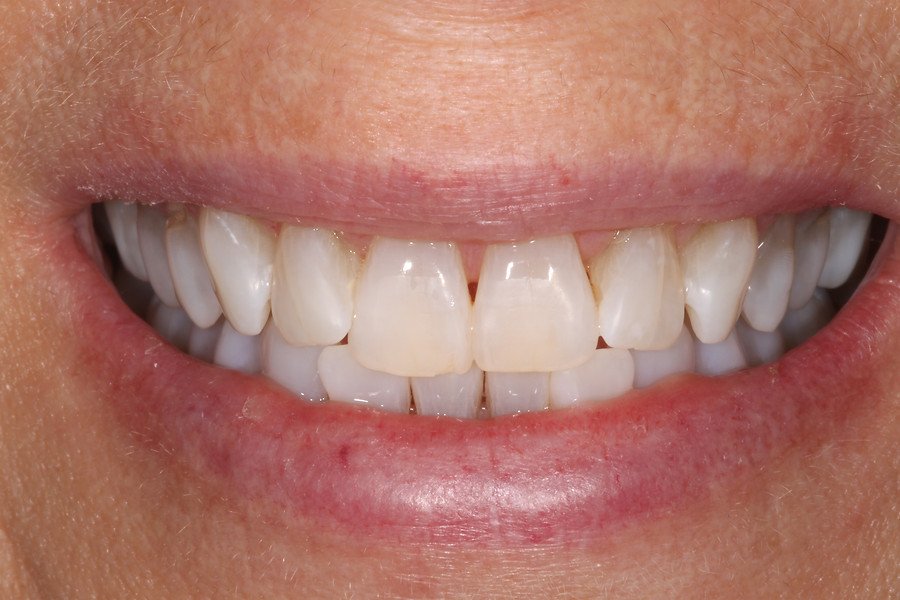 Professional Whitening — after