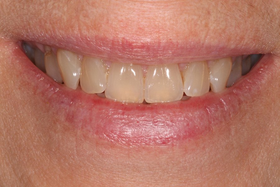 Professional Whitening — before