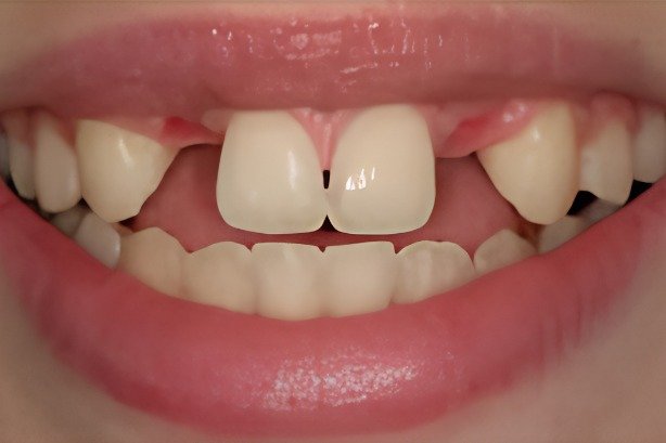 Dental Implants — before 1
