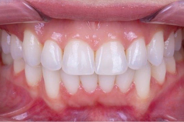 Braces — after 2