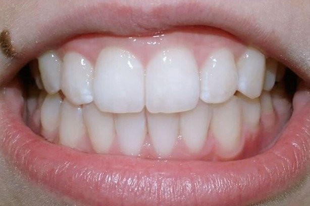 Braces