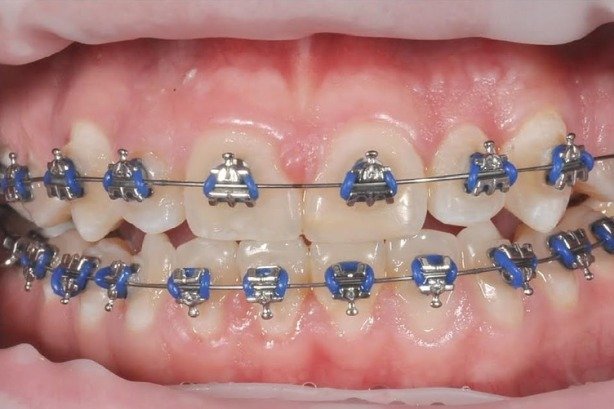 Braces — after 3