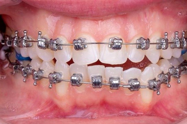 Braces — before 2