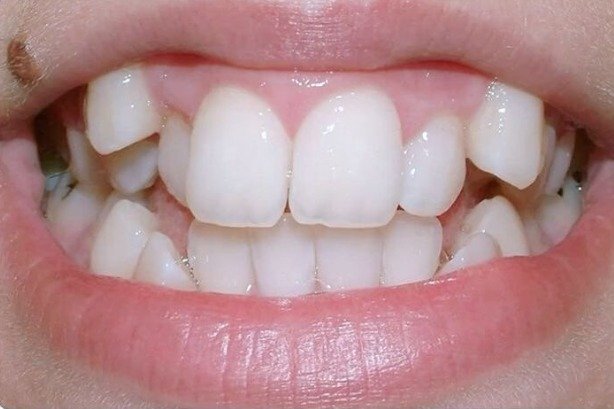Braces