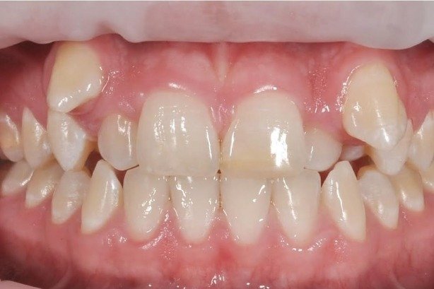 Braces — before 3