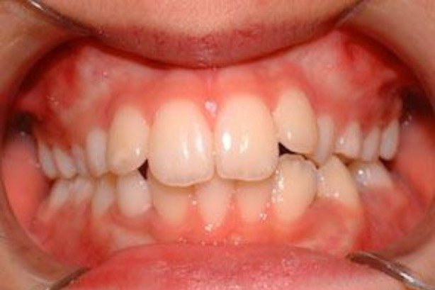 Orthodontics — before